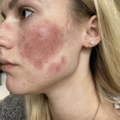 Young woman showing her face area affected by eczema after using the OMNILUX CONTOUR medical grade mask for one week.