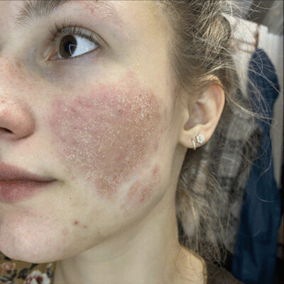 Young woman showing the eczema affected area on her cheek before her LED light eczema therapy with the OMNILUX CONTOUR Mask.